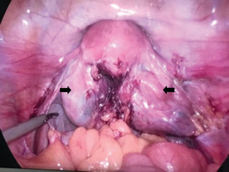 Laparoscopy showing bilateral hydrosalpinxs, tubo-ovarian masses, adhesions and frozen pelvis (arrows).